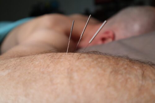 “#1 Guide” - Understanding Japanese Acupuncture - 3 Acupuncture CEUs/PDAs
