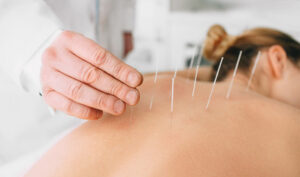 "12 Tips" Acupuncture for Sports Injuries - 5 Acupuncture CEUs/PDAs