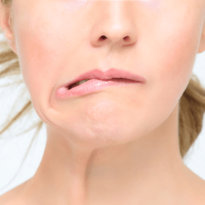 A Basic Guide to Understanding Bell's Palsy - 3 Acupuncture CEUs/PDAs