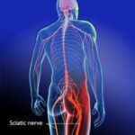 5 CEUs Sciatica A&P - FL Only