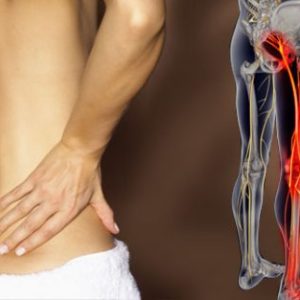 5 CEUs Sciatica Symptoms - FL Only